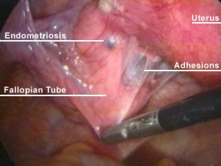 Endometriosis more common in lean women: study