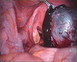 Pictures of endometriosis including images of cysts and adhesions taken during surgery