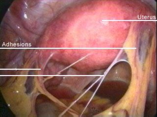 endometriosis adhesions