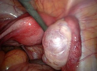 ovarian endometriosis