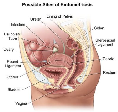 Locations of endometriosis