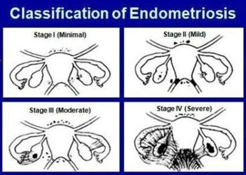 Endometriosis Stages Chart