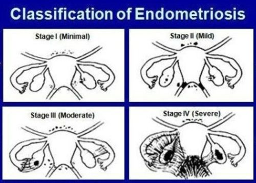 Endometriosis Chart