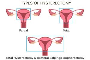 Endometriosis and hysterectomy