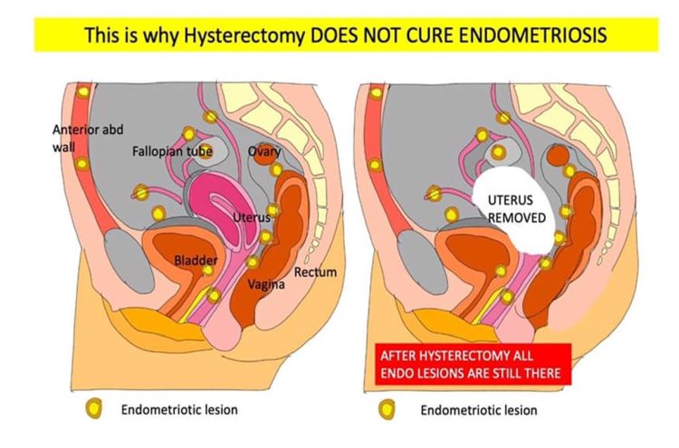 Endometriosis and hysterectomy