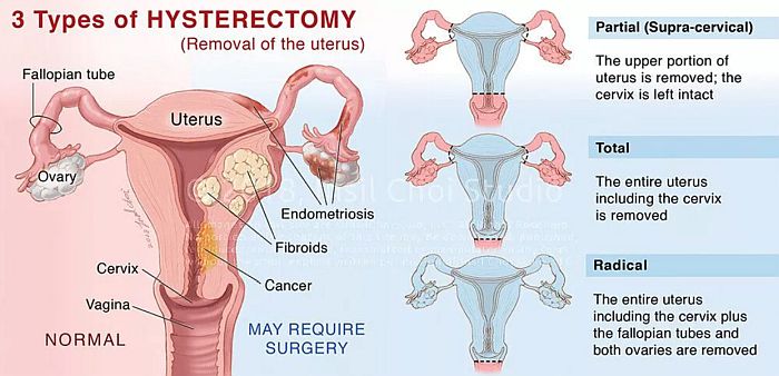 hysterectomy types