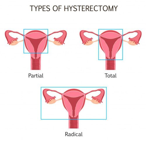 hysterectomy types