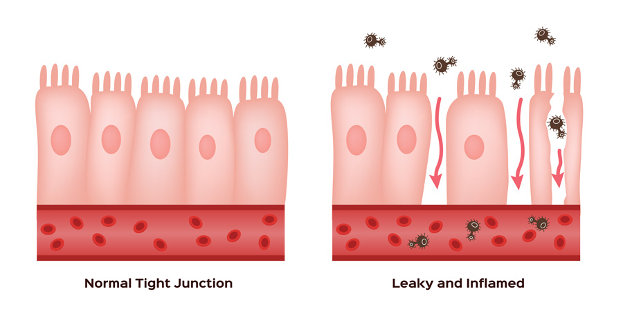 Leaky Gut graphic Leaky Gut graphic