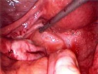 Endometriosis powder burn lesion