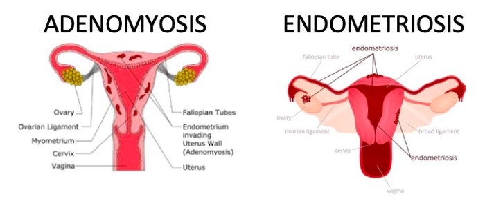 Adenomyosis versus endometriosis