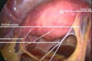 Endometriosis adhesions and how they are formed