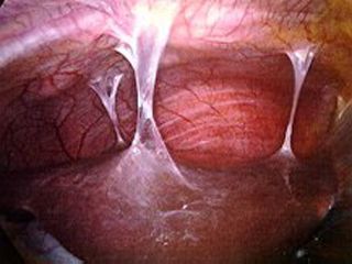 Endometriosis adhesions