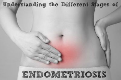 endometriosis stages