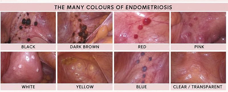 The different colours of endometriosis The different colours of endometriosis