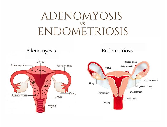 Endometriosis and adenomyosis