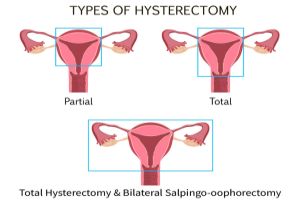 Endometriosis and hysterectomy