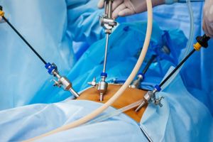 Laparoscopy for the diagnosis and treatment of endometriosis