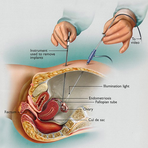 laparoscopy surgery for endometriosis