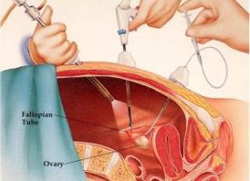 Additional surgical procedures used to treat endometriosis